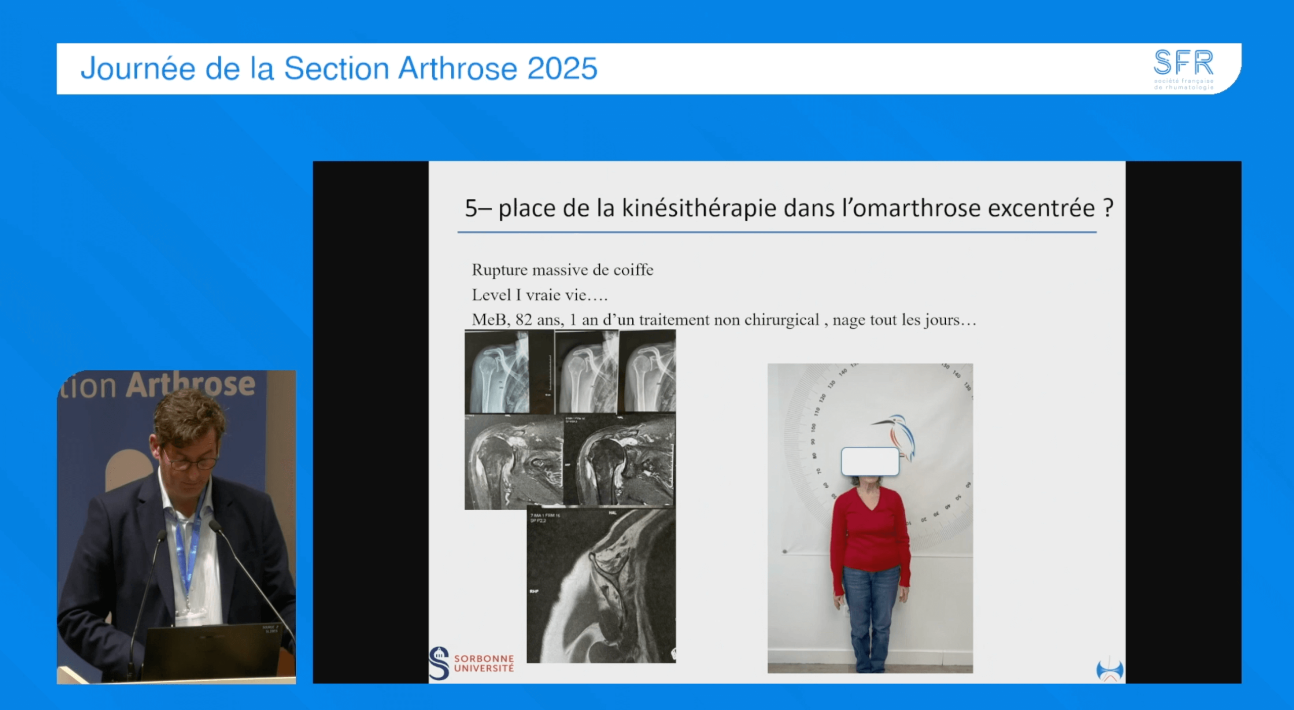 Chirurgie-omarthrose Actualité de la chirurgie de l’omarthrose
