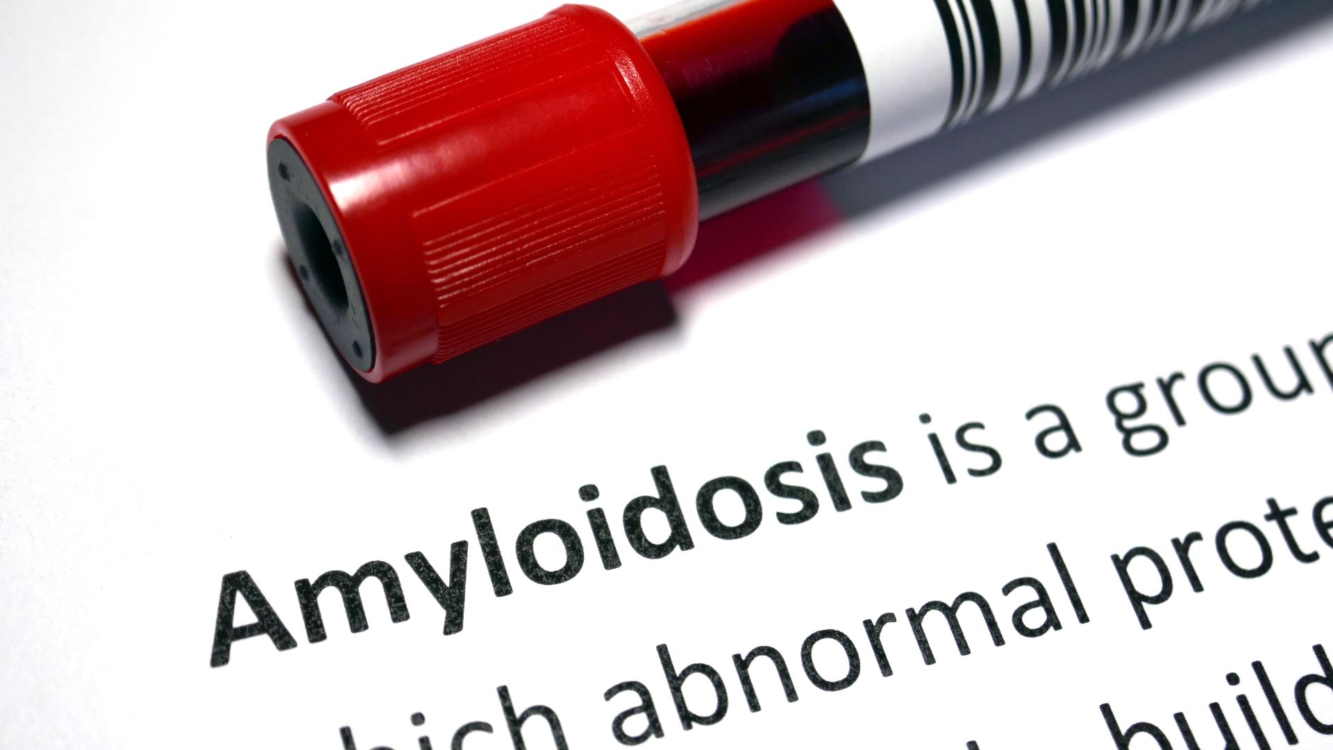 Manifestations rhumatologiques de l’amylose à transthyrétine (ATTR)