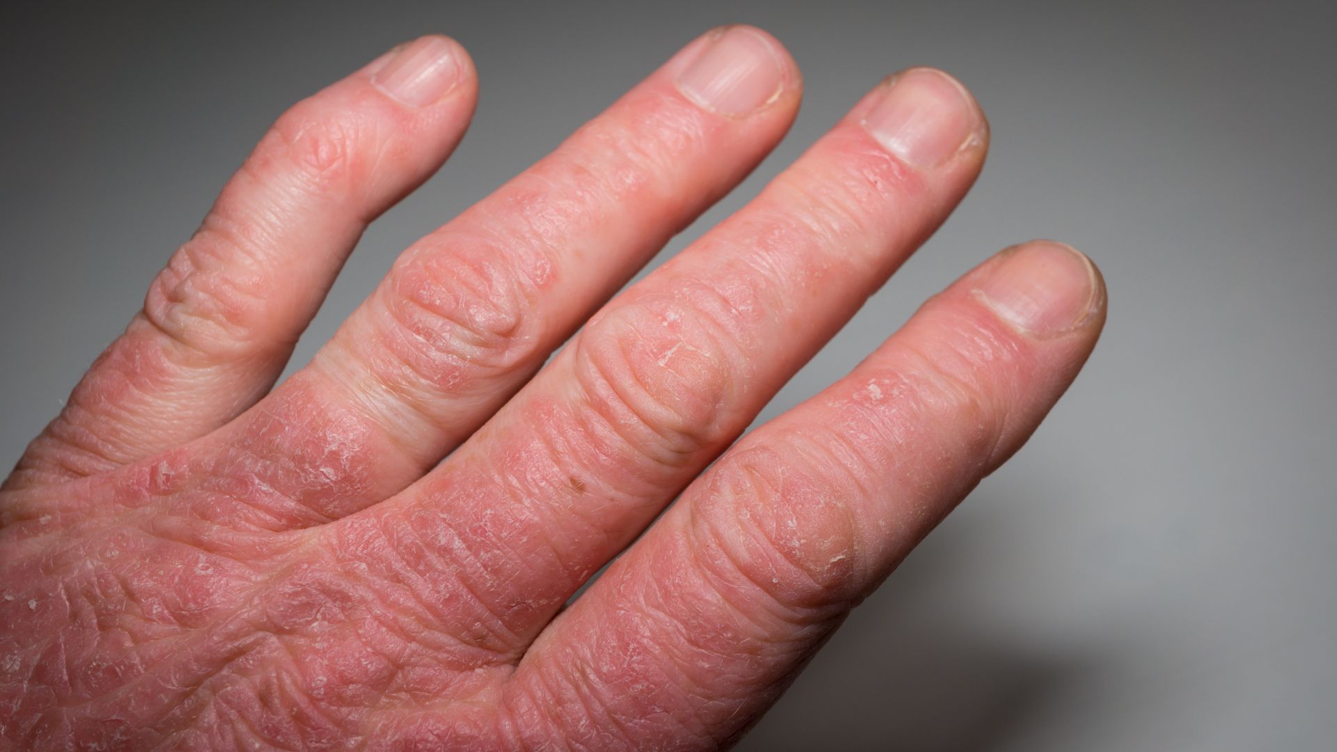 Étude TOGETHER-PsA : traiter le poids pour mieux contrôler le rhumatisme psoriasique ?