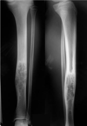 Essai de phase II du burosumab dans le traitement de l’hypophosphatémie médiée par le FGF23 chez les enfants et adultes atteints de dysplasie fibreuse des os