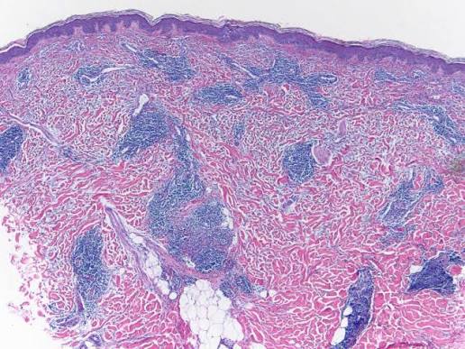Efficacité de l&rsquo;obinutuzumab dans le lupus érythémateux systémique actif