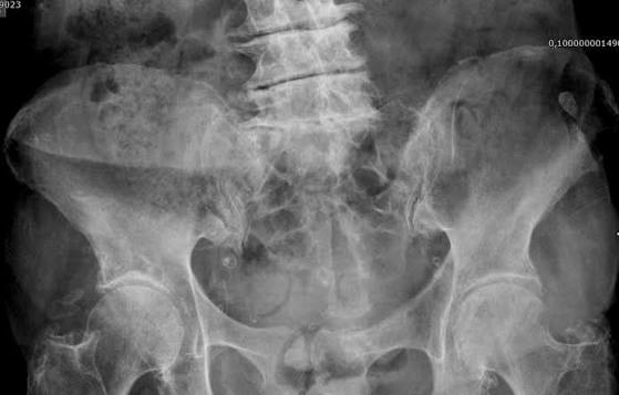Diagnostic de la maladie liée au dépôt de cristaux de pyrophosphate de calcium par échographie : combien et quels sites faut-il examiner ?