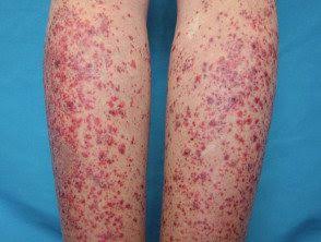 Pneumopathie interstitielle du syndrome de Sjögren : prévalence, incidence et mortalité (étude prospective EMERGE)