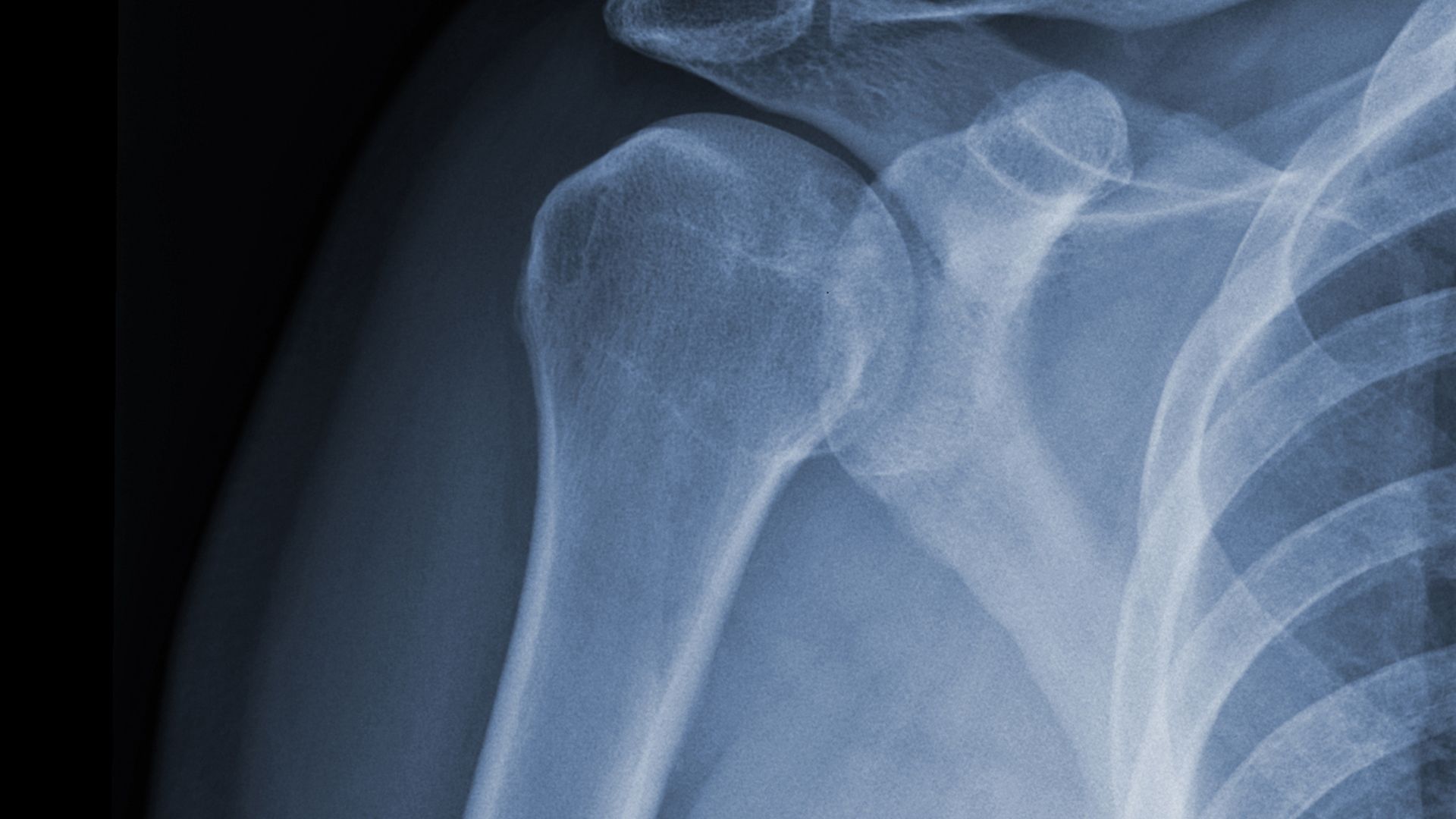 Dépistage de la cardiomyopathie amyloïde à transthyrétine chez les patients présentant des symptômes musculo-squelettiques : signes d&rsquo;alerte en pratique rhumatologique et orthopédique