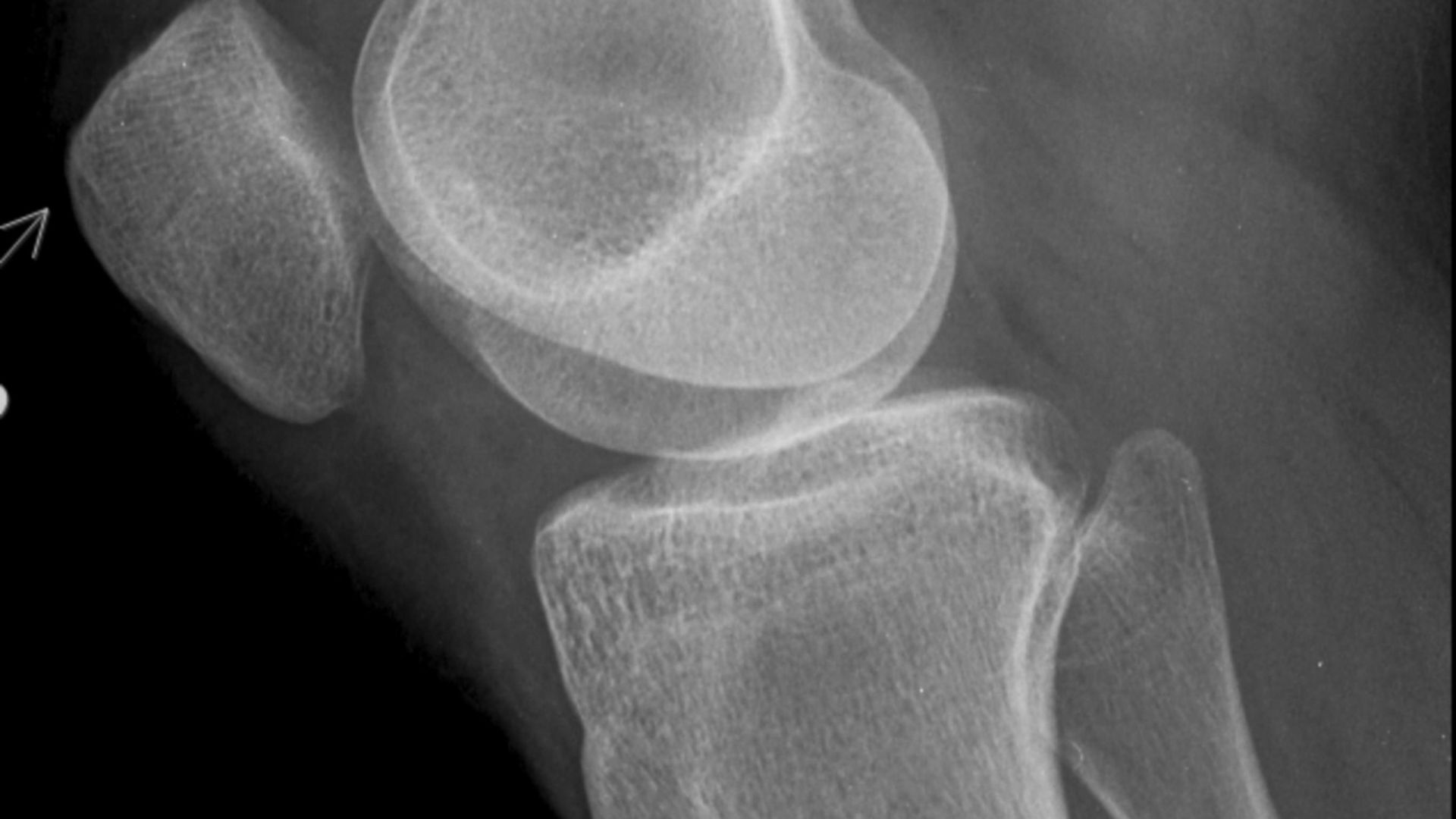 Fracture sous-chondrale : recherchez l&rsquo;ostéoporose !