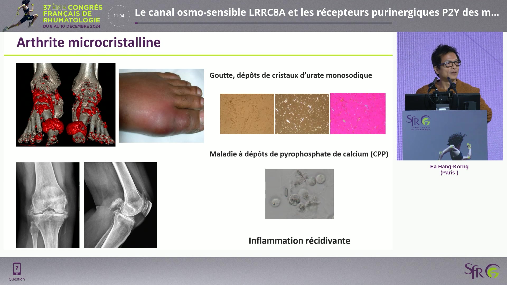 Le canal osmo-sensible LRRC8A et les récepteurs purinergiques P2Y des macrophages occupent une place centrale dans l’inflammation microcristalline