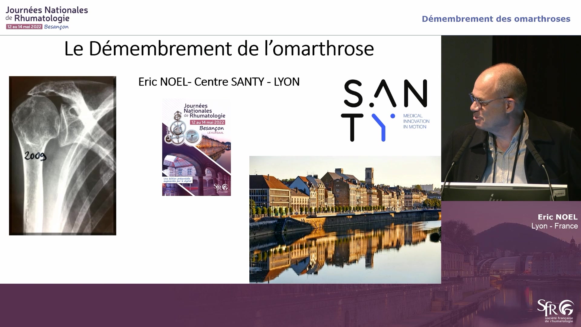 Démembrement des omarthroses
