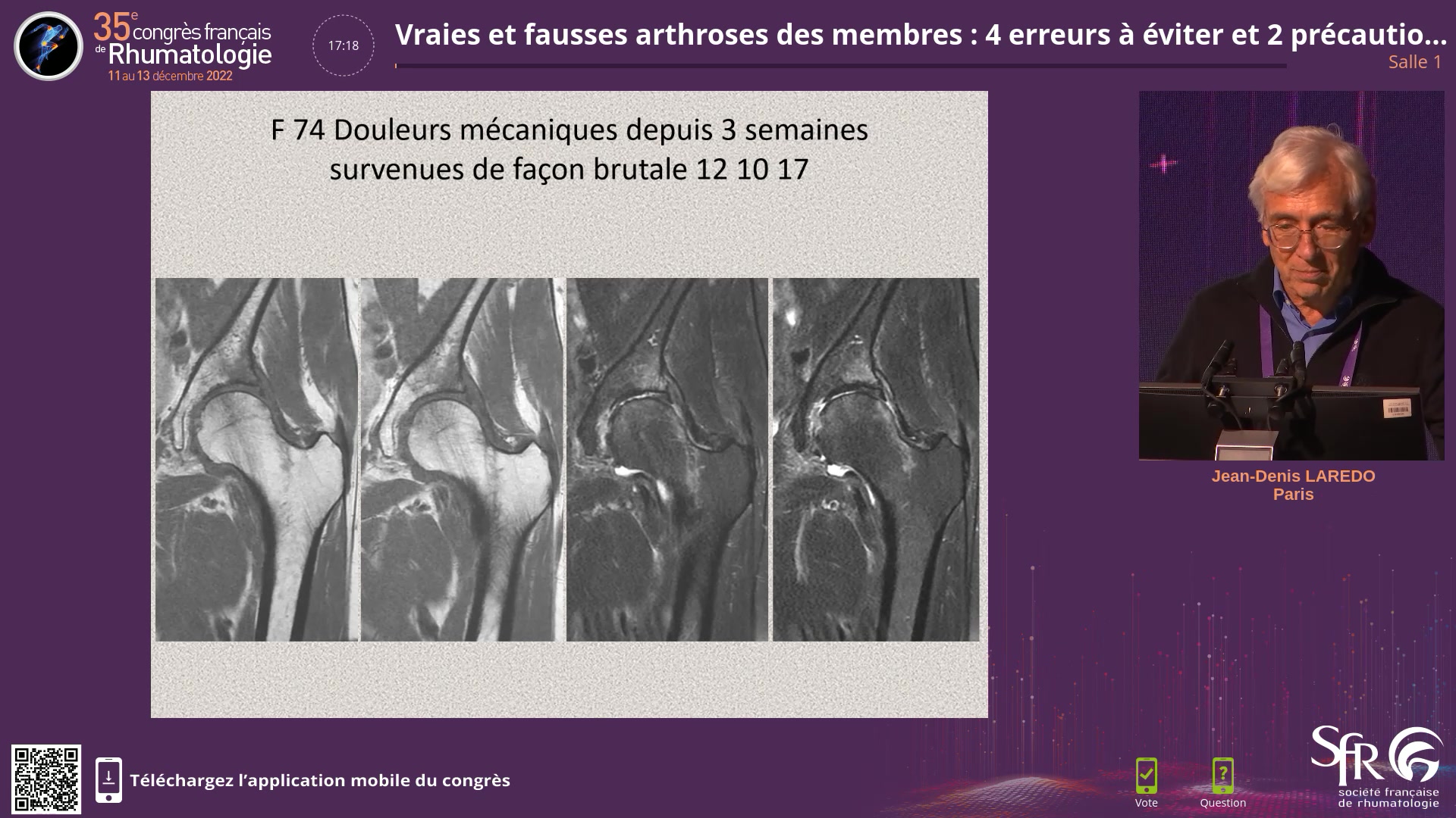 Vraies et fausses arthroses des membres : 4 erreurs à éviter et 2 précautions à prendre