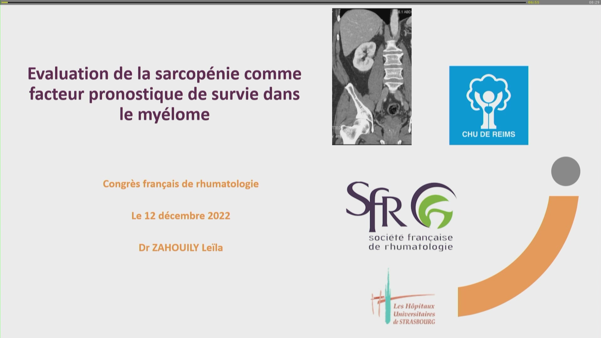 Évaluation de la sarcopénie comme facteur pronostique de survie chez les patients atteints de myélome multiple