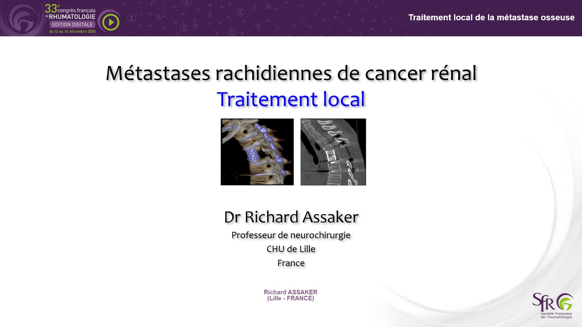 Traitement local de la métastase osseuse