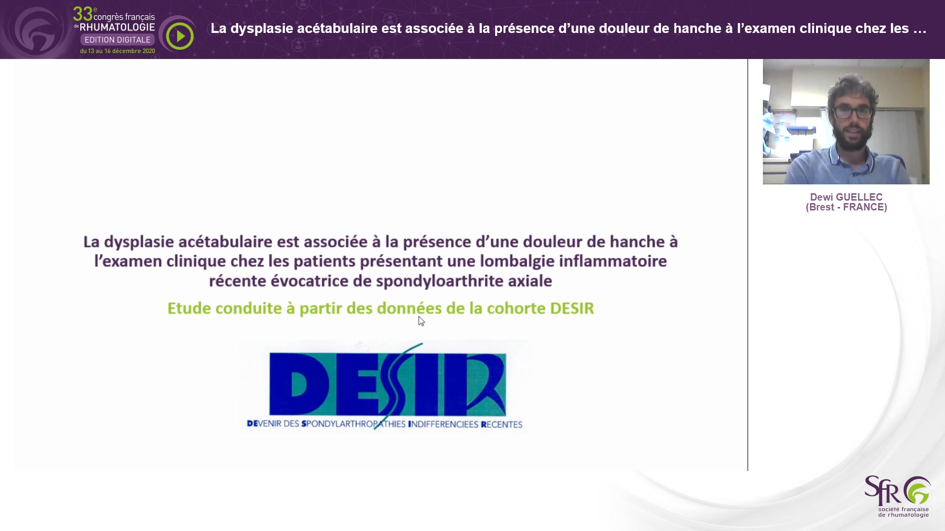 La dysplasie acétabulaire est associée à la présence d’une douleur de hanche à l’examen clinique chez les patients présentant une lombalgie inflammatoire récente évocatrice de spondyloarthrite axiale